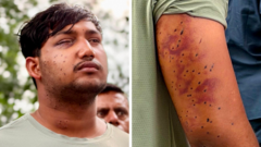India&rsquo;s &lsquo;cockroach&rsquo; protesters have wounds consistent with pellet-gun fire, say experts